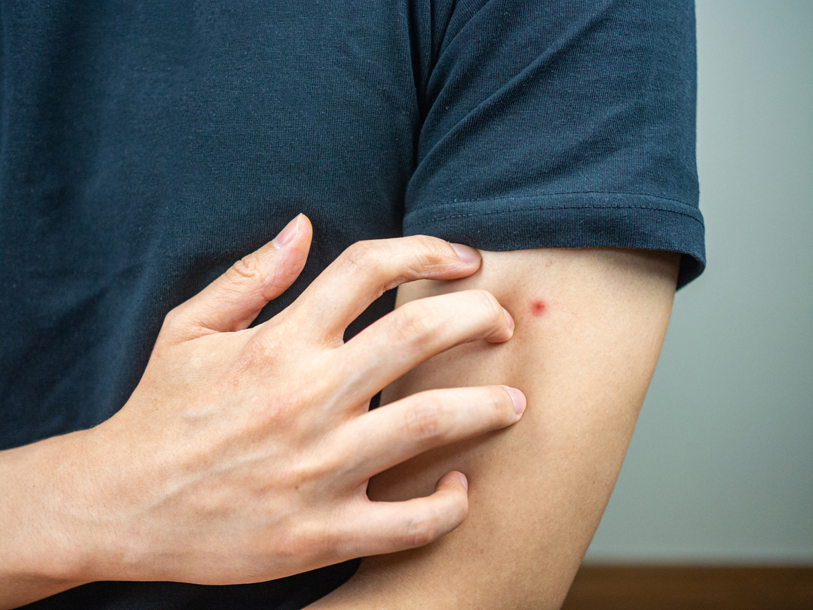 A person wearing a dark blue shirt scratches at a bug bite on their upper arm.